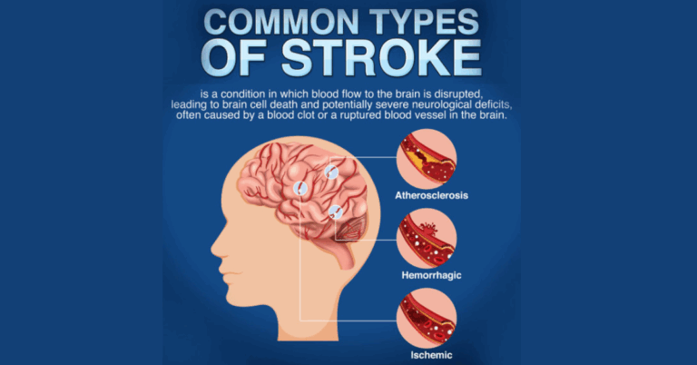 TMS For Stroke: A New Era in Stroke Rehabilitation